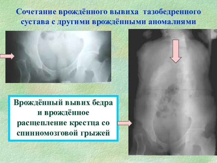 Сочетание врождённого вывиха тазобедренного сустава с другими врождёнными аномалиями Врождённый