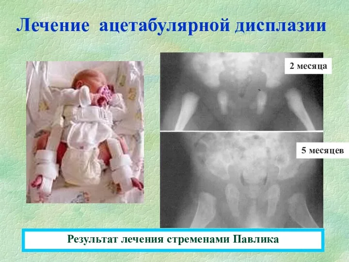 Лечение ацетабулярной дисплазии Результат лечения стременами Павлика 2 месяца 5 месяцев