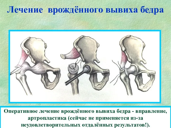 Лечение врождённого вывиха бедра Оперативное лечение врождённого вывиха бедра -