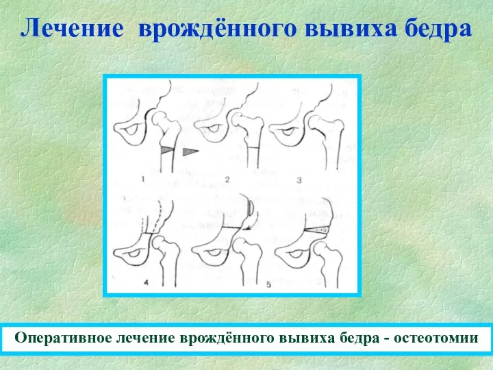 Лечение врождённого вывиха бедра Оперативное лечение врождённого вывиха бедра - остеотомии