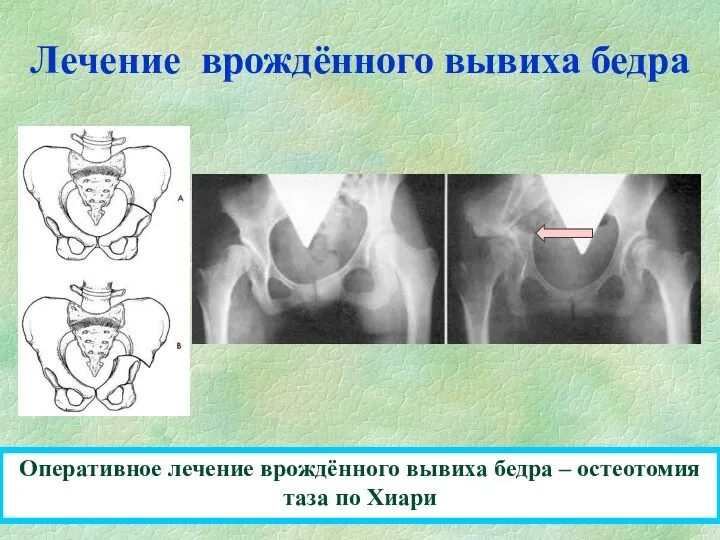 Лечение врождённого вывиха бедра Оперативное лечение врождённого вывиха бедра – остеотомия таза по Хиари