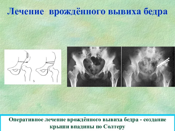 Лечение врождённого вывиха бедра Оперативное лечение врождённого вывиха бедра - создание крыши впадины по Солтеру