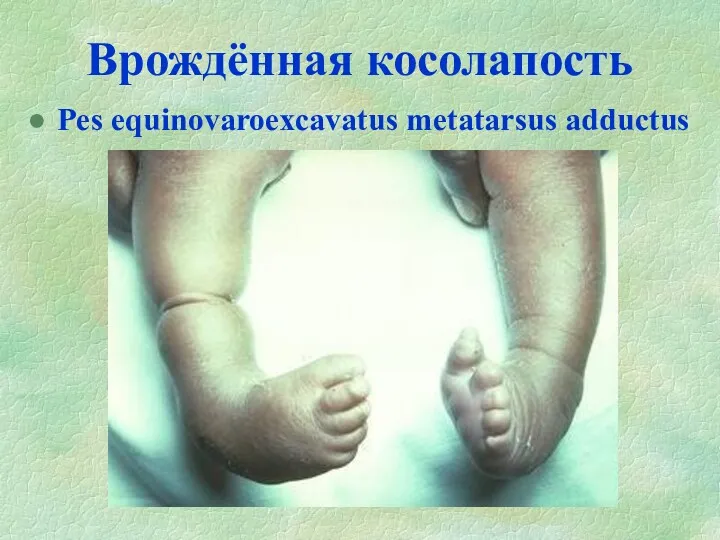 Врождённая косолапость Pes equinovaroexcavatus metatarsus adductus