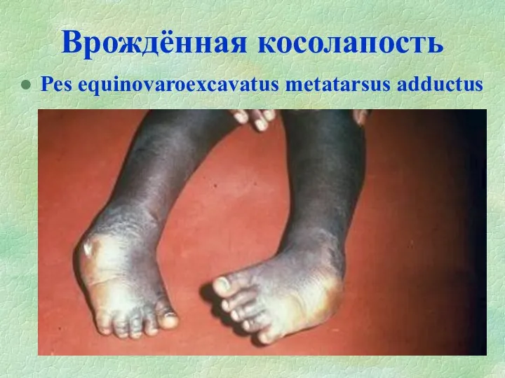 Врождённая косолапость Pes equinovaroexcavatus metatarsus adductus