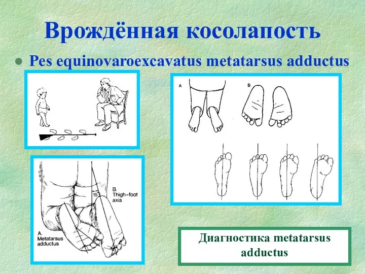 Врождённая косолапость Pes equinovaroexcavatus metatarsus adductus Диагностика metatarsus adductus