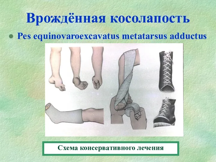 Врождённая косолапость Pes equinovaroexcavatus metatarsus adductus Схема консервативного лечения