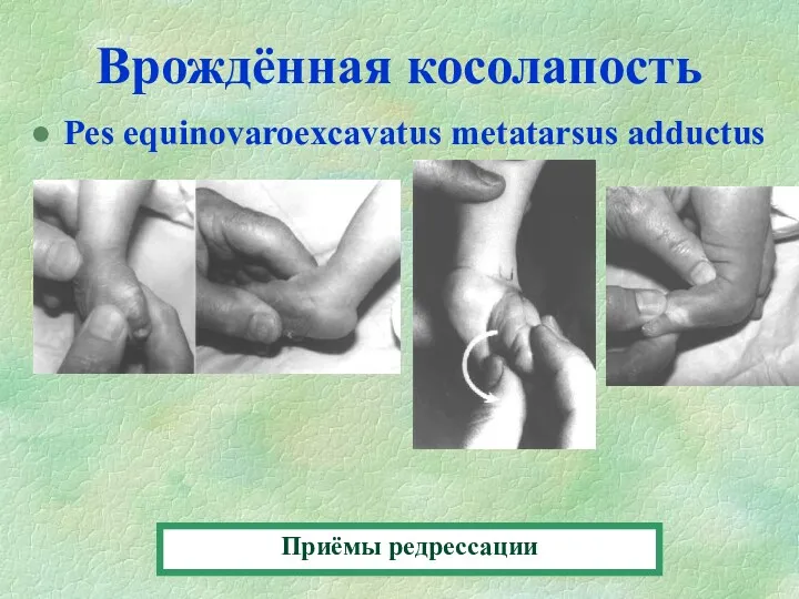 Врождённая косолапость Pes equinovaroexcavatus metatarsus adductus Приёмы редрессации