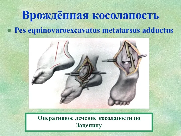 Врождённая косолапость Pes equinovaroexcavatus metatarsus adductus Оперативное лечение косолапости по Зацепину