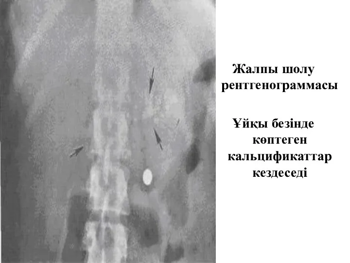 Жалпы шолу рентгенограммасы Ұйқы безінде көптеген кальцификаттар кездеседі