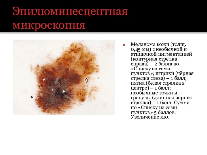 Эпилюминесцентная микроскопия Меланома кожи (толщ. 0,45 мм) с необычной и