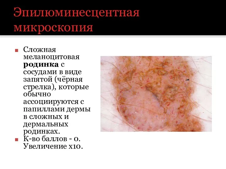 Эпилюминесцентная микроскопия Сложная меланоцитовая родинка с сосудами в виде запятой