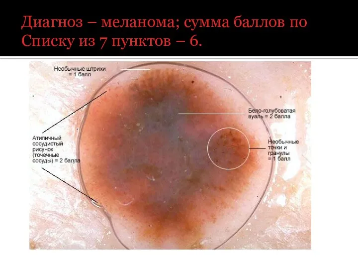 Диагноз – меланома; сумма баллов по Списку из 7 пунктов – 6.