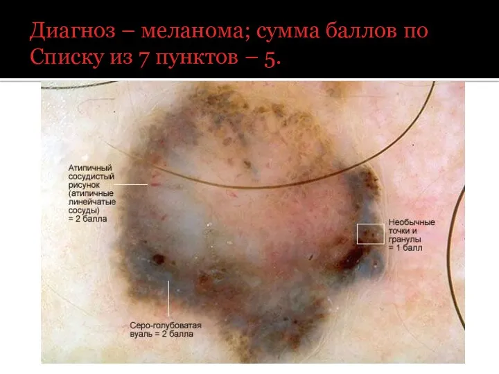 Диагноз – меланома; сумма баллов по Списку из 7 пунктов – 5.