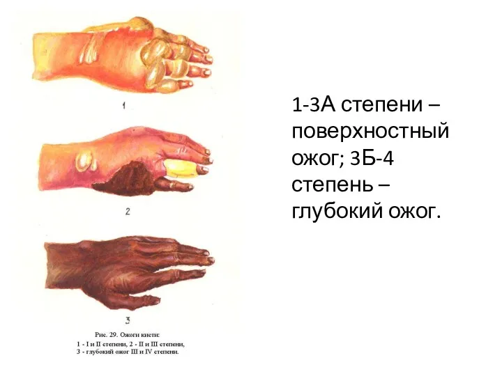 1-3А степени – поверхностный ожог; 3Б-4 степень – глубокий ожог.