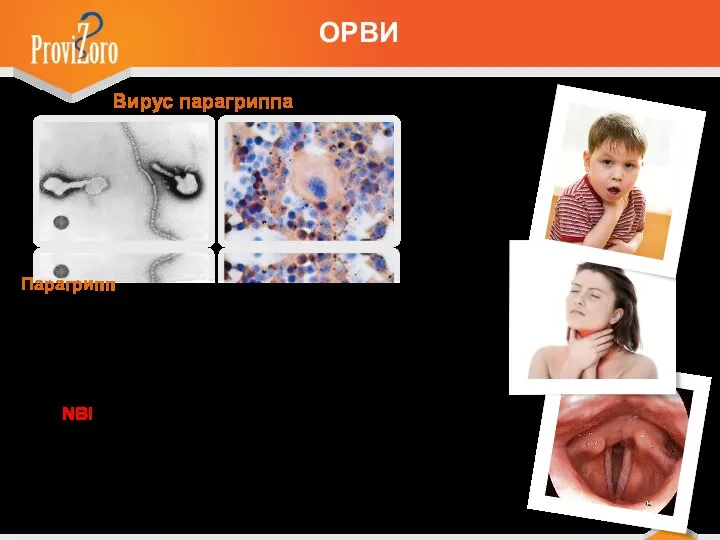 Вирус парагриппа Парагрипп Болезнь начинается с того, что у человека