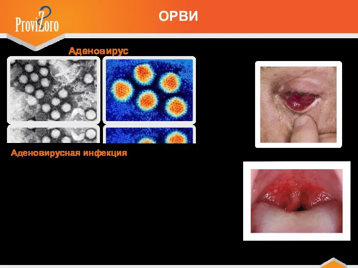 Аденовирус ОРВИ Аденовирусная инфекция – самый частый вариант ОРВИ. Болезнь