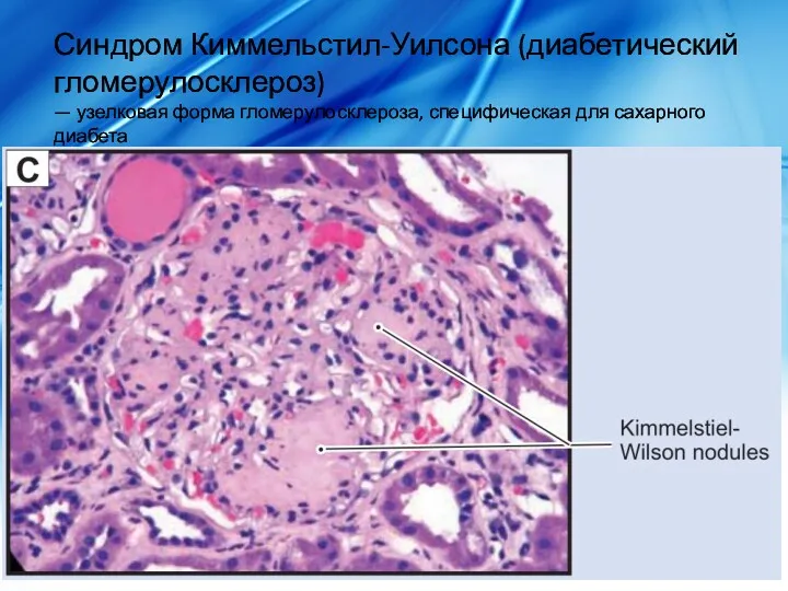 Синдром Киммельстил-Уилсона (диабетический гломерулосклероз) — узелковая форма гломерулосклероза, специфическая для сахарного диабета