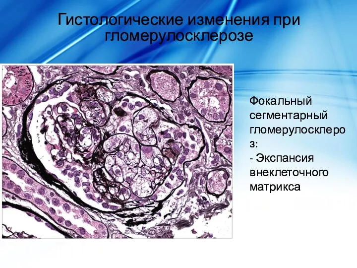 Гистологические изменения при гломерулосклерозе Фокальный сегментарный гломерулосклероз: - Экспансия внеклеточного матрикса