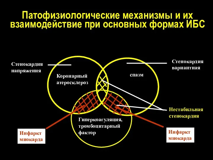 Патофизиологические механизмы и их взаимодействие при основных формах ИБС Коронарный атеросклероз Гиперкоагуляция, тромбоцитарный