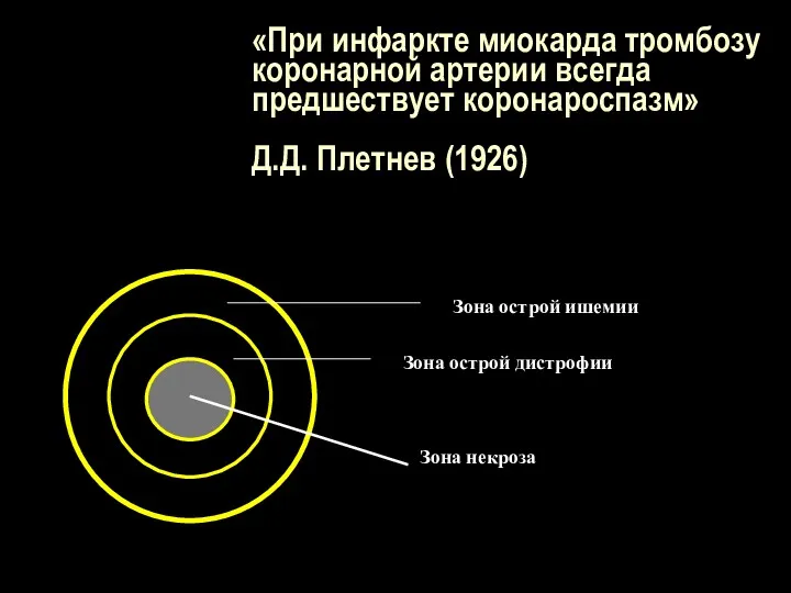 «При инфаркте миокарда тромбозу коронарной артерии всегда предшествует коронароспазм» Д.Д. Плетнев (1926) Зона