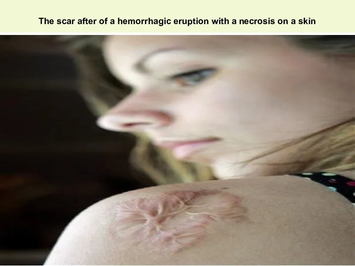 The scar after of a hemorrhagic eruption with a necrosis on a skin