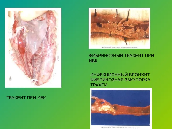 ТРАХЕИТ ПРИ ИБК ФИБРИНОЗНЫЙ ТРАХЕИТ ПРИ ИБК ИНФЕКЦИОННЫЙ БРОНХИТ ФИБРИНОЗНАЯ ЗАКУПОРКА ТРАХЕИ