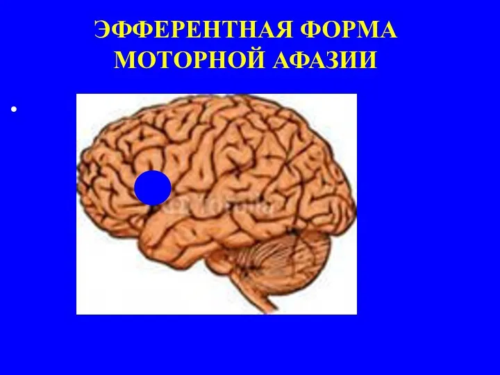 ЭФФЕРЕНТНАЯ ФОРМА МОТОРНОЙ АФАЗИИ