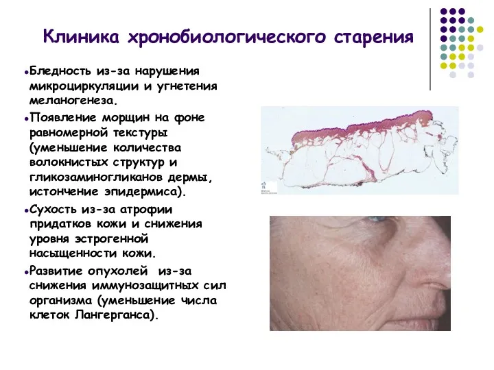 Клиника хронобиологического старения Бледность из-за нарушения микроциркуляции и угнетения меланогенеза.
