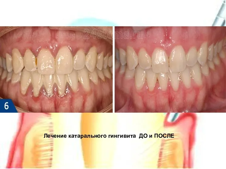 Лечение катарального гингивита ДО и ПОСЛЕ