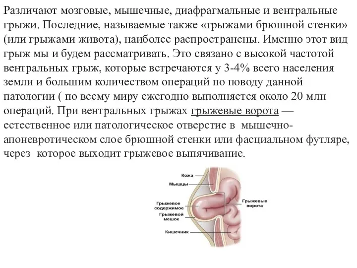 Различают мозговые, мышечные, диафрагмальные и вентральные грыжи. Последние, называемые также