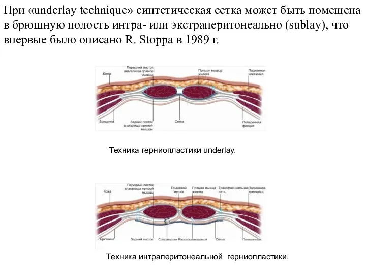 При «underlay technique» синтетическая сетка может быть помещена в брюшную