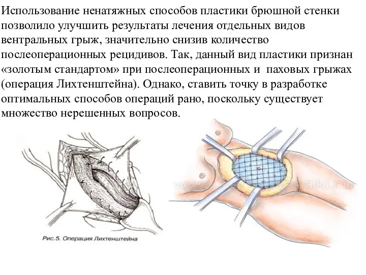 Использование ненатяжных способов пластики брюшной стенки позволило улучшить результаты лечения