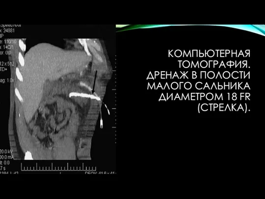 КОМПЬЮТЕРНАЯ ТОМОГРАФИЯ. ДРЕНАЖ В ПОЛОСТИ МАЛОГО САЛЬНИКА ДИАМЕТРОМ 18 FR (СТРЕЛКА).