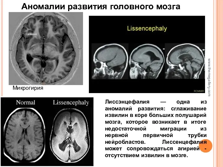 www.themegallery.com Микрогирия Лиссэнцефалия — одна из аномалий развития: сглаживание извилин