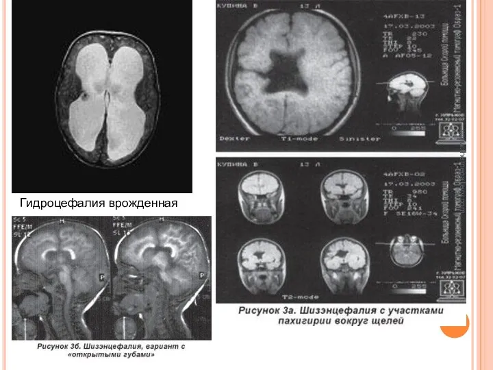www.themegallery.com Гидроцефалия врожденная
