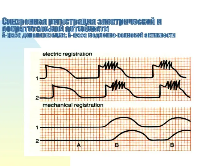 Синхронная регистрация электрической и сократительной активности А-фаза деполяризации; В-фаза медленно-волновой активности