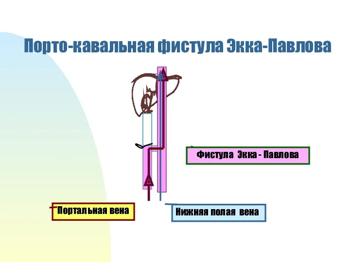 Порто-кавальная фистула Экка-Павлова Портальная вена Нижняя полая вена Фистула Экка - Павлова