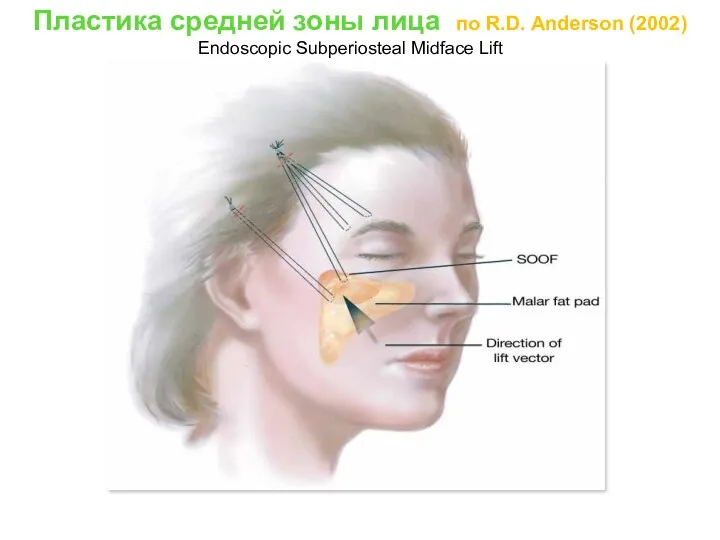Пластика средней зоны лица по R.D. Anderson (2002) Endoscopic Subperiosteal Midface Lift
