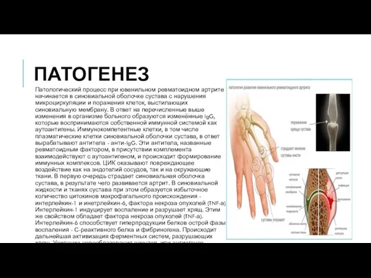 ПАТОГЕНЕЗ Патологический процесс при ювенильном ревматоидном артрите начинается в синовиальной