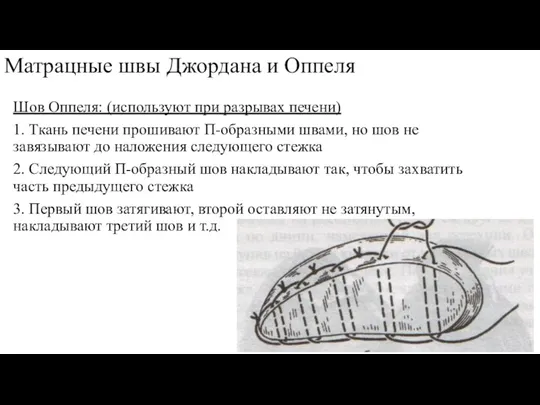 Матрацные швы Джордана и Оппеля Шов Оппеля: (используют при разрывах