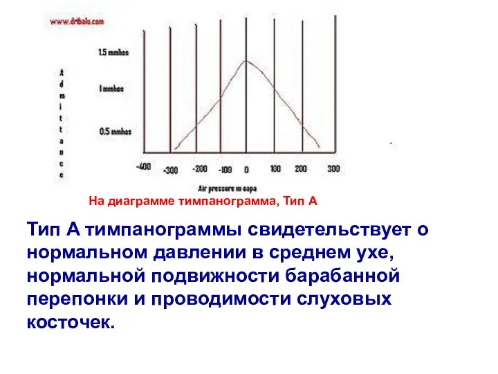 На диаграмме тимпанограмма, Тип A Тип A тимпанограммы свидетельствует о