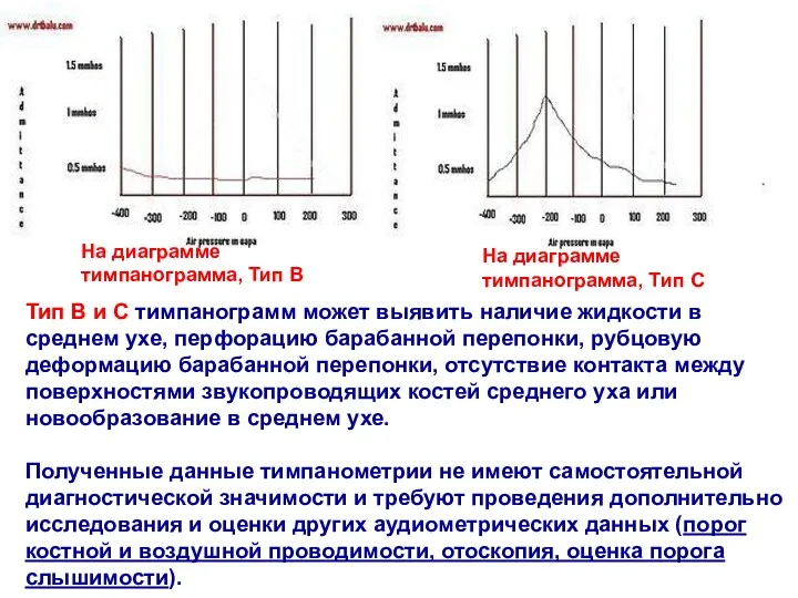 На диаграмме тимпанограмма, Тип B На диаграмме тимпанограмма, Тип С