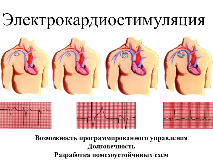 Электрокардиостимуляция Возможность программированного управления Долговечность Разработка помехоустойчивых схем