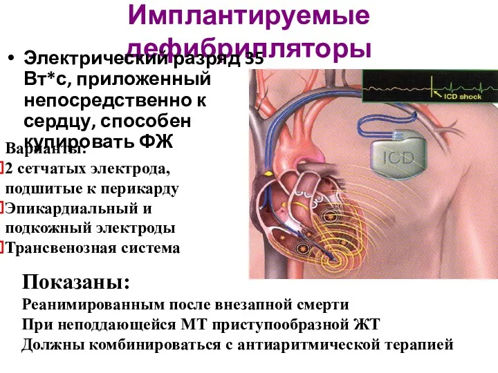 Имплантируемые дефибрилляторы Электрический разряд 35 Вт*с, приложенный непосредственно к сердцу,