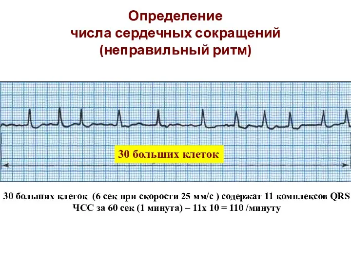 Определение числа сердечных сокращений (неправильный ритм) 30 больших клеток 30