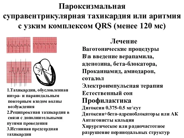 Пароксизмальная суправентрикулярная тахикардия или аритмия с узким комплексом QRS (менее