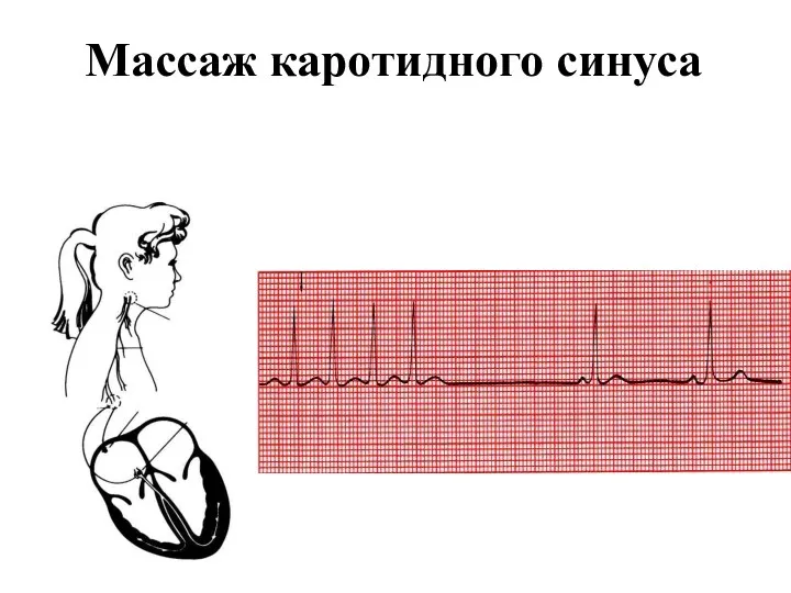 Массаж каротидного синуса
