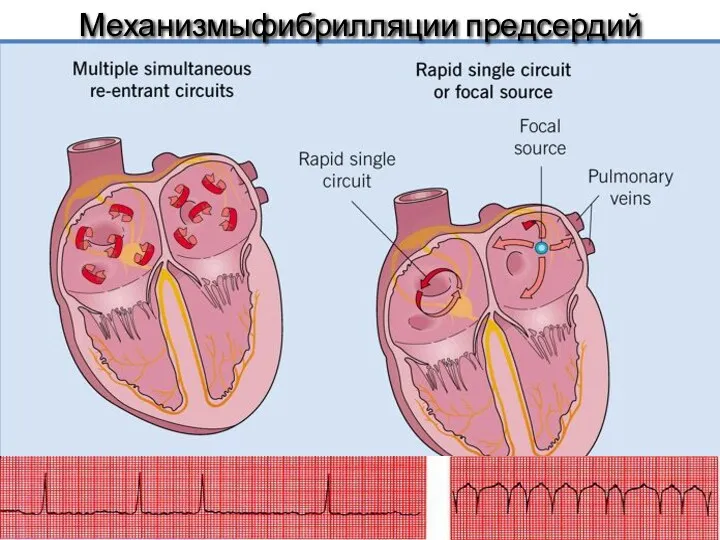 Механизмыфибрилляции предсердий