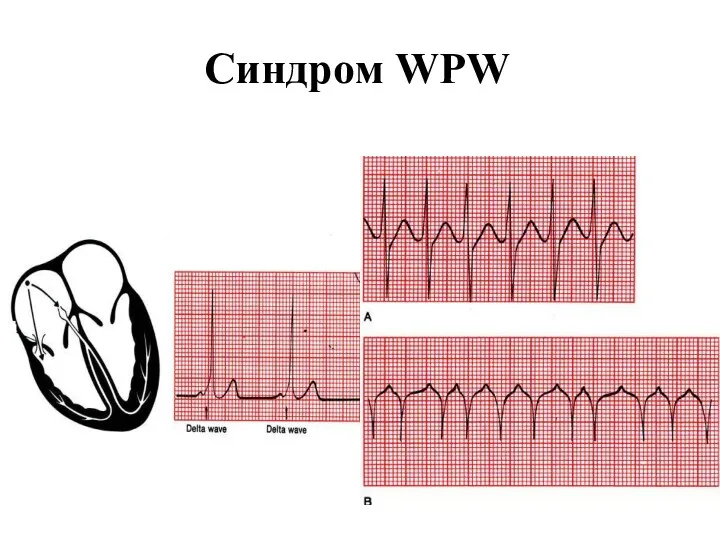 Синдром WPW