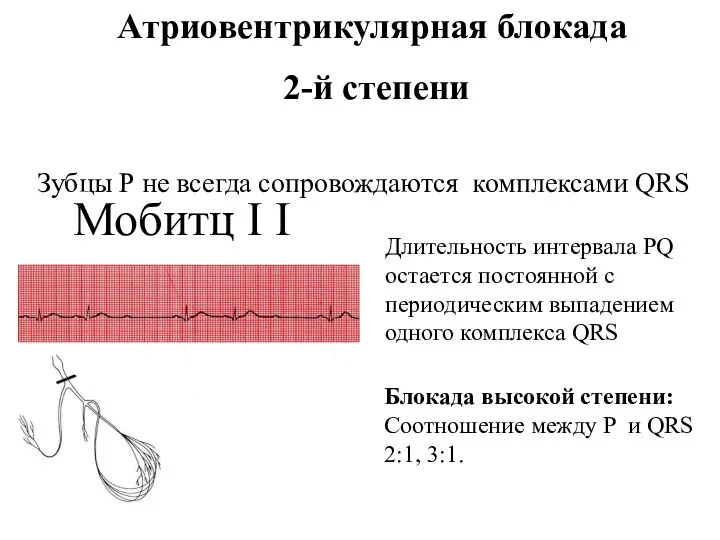 Атриовентрикулярная блокада 2-й степени Зубцы Р не всегда сопровождаются комплексами